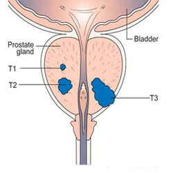 Prostatitis trutne tej Hosszúságú gyertyák az orvosok prosztatájával